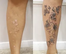 Cobertura de cicatriz na região da panturrilha