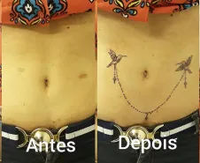  Cobertura de cicatriz na barriga