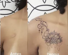 cobertura de cicatriz na região do peito