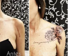 cobertura de cicatriz no ombro