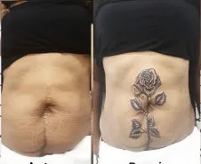 Cobertura de cicatriz abdominal 