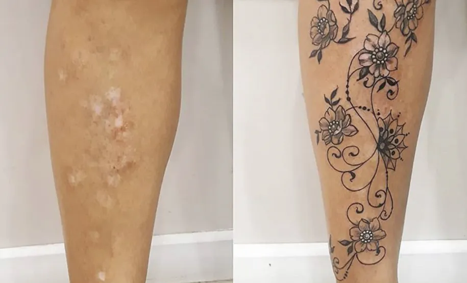 Cobertura de cicatriz na região da panturrilha