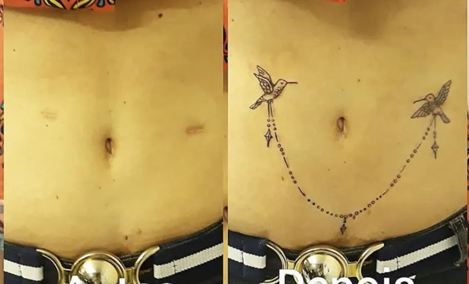 Cobertura de cicatriz na barriga