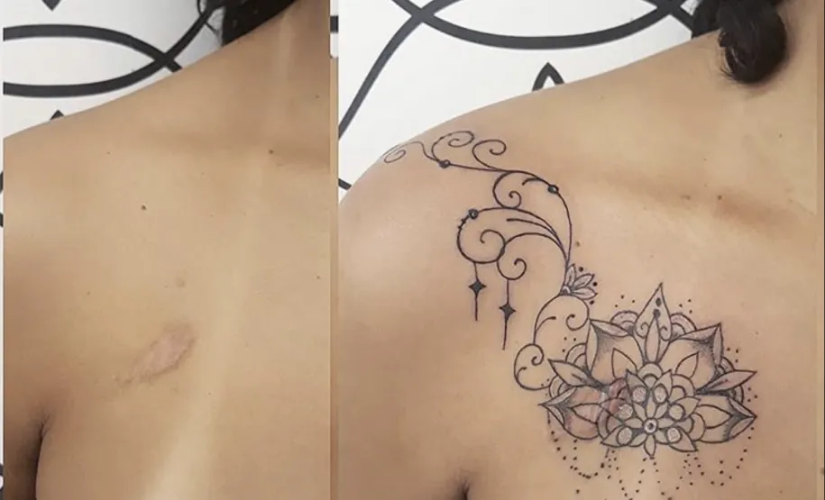 cobertura de cicatriz na região do peito