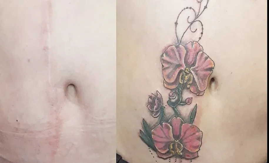 Cobertura de cicatriz abdominal