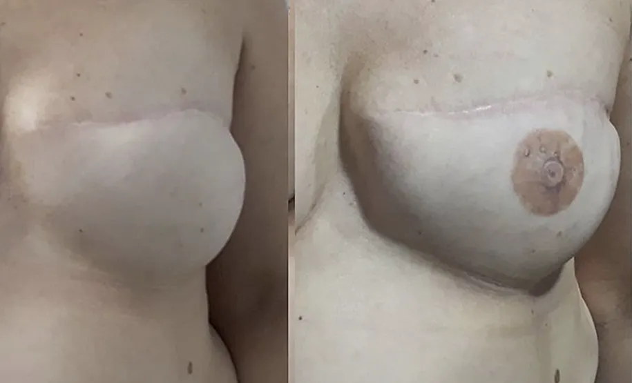 Reconstrução da auréola mamária após cirurgia de remoção de mama