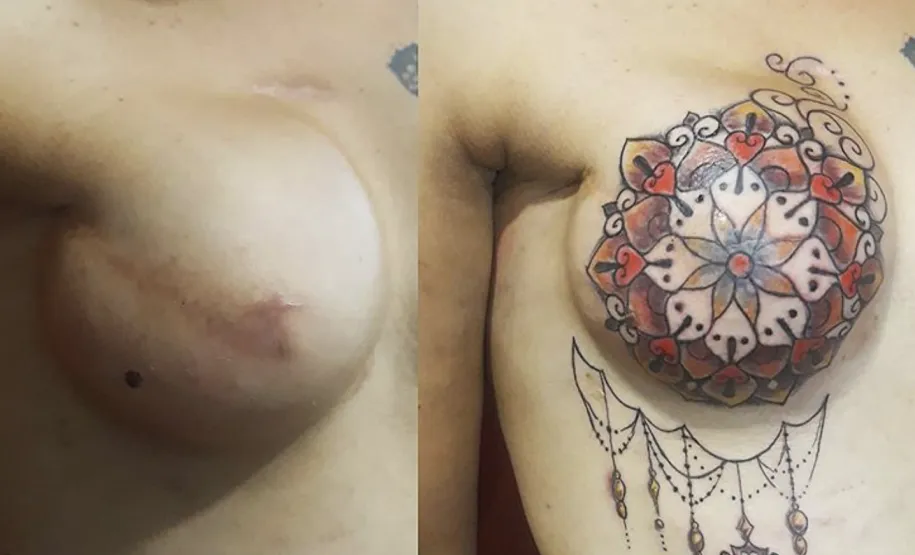 Cobertura de cicatriz na região da mama após cirurgia de remoção