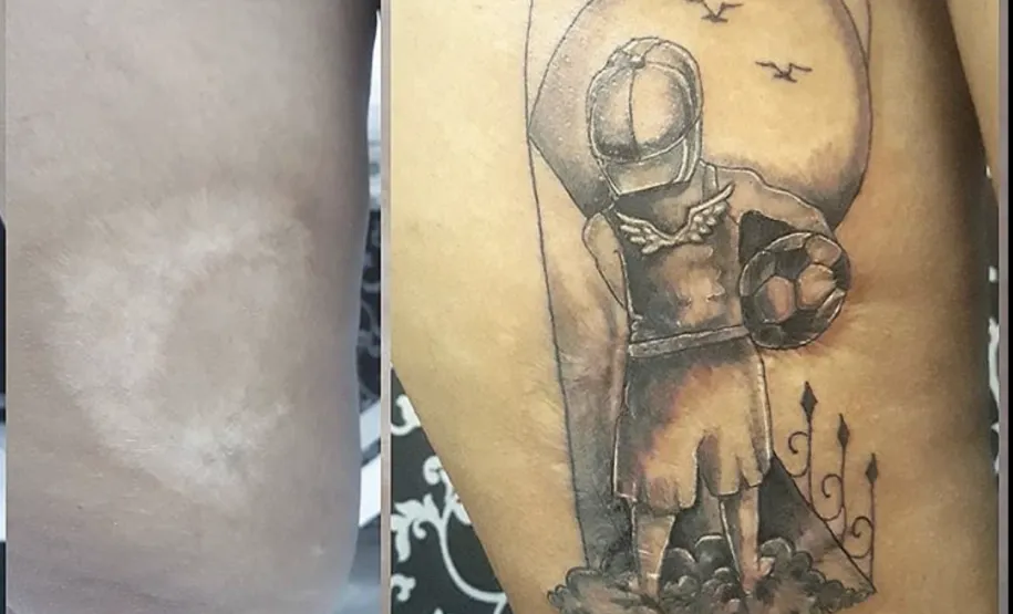 cobertura de cicatriz na parte inferior do joelho