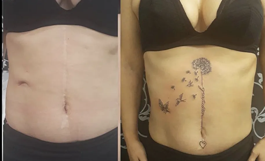 Cobertura de cicatriz abdominal