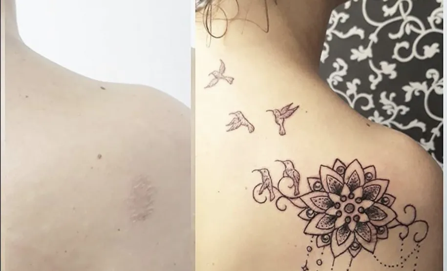 Cobertura de cicatriz na região posterior do ombro