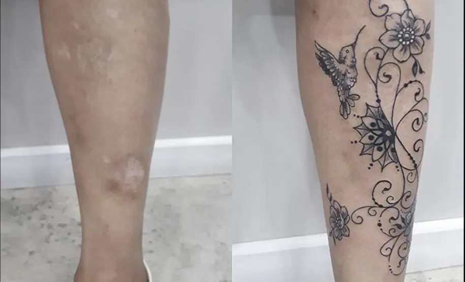 cobertura de cicatriz na região da canela