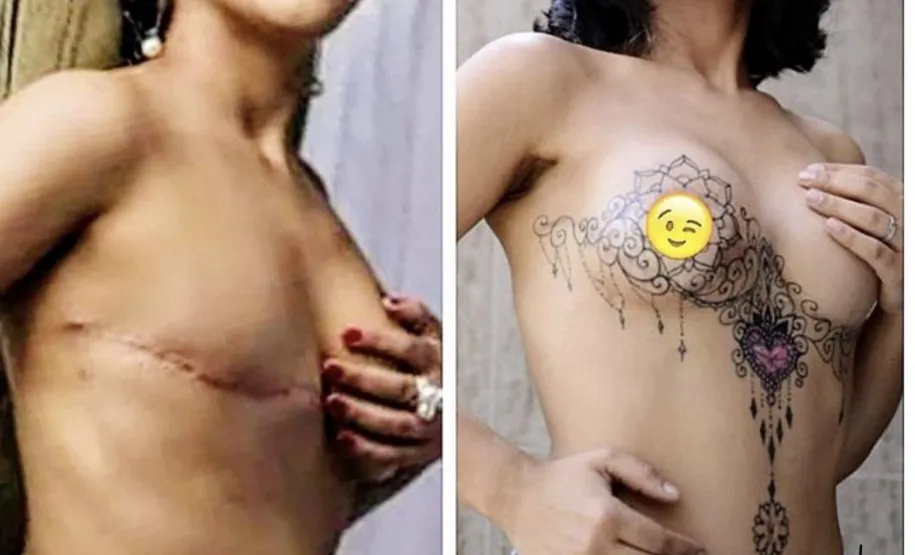 Cobertura de cicatriz e recriação da auréola mamária