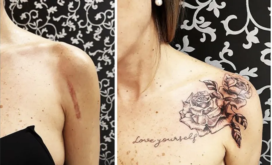 cobertura de cicatriz no ombro