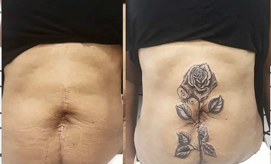 Cobertura de cicatriz abdominal