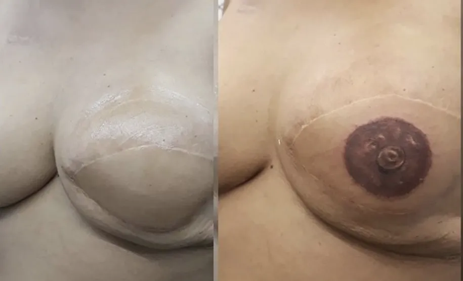 Reconstrução da auréola mamária após cirurgia de remoção das mamas