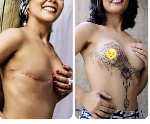 Cobertura de cicatriz e recriação da auréola mamária 